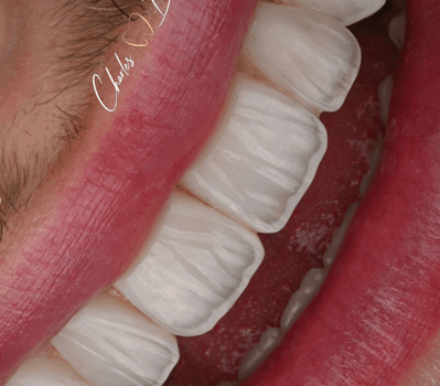 Composite Veneers by Dr Charles Brandon