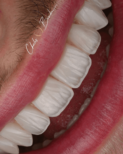 Composite Veneers by Dr Charles Brandon