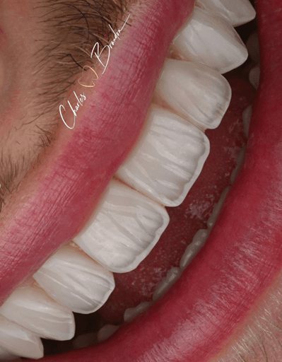 Composite Veneers by Dr Charles Brandon